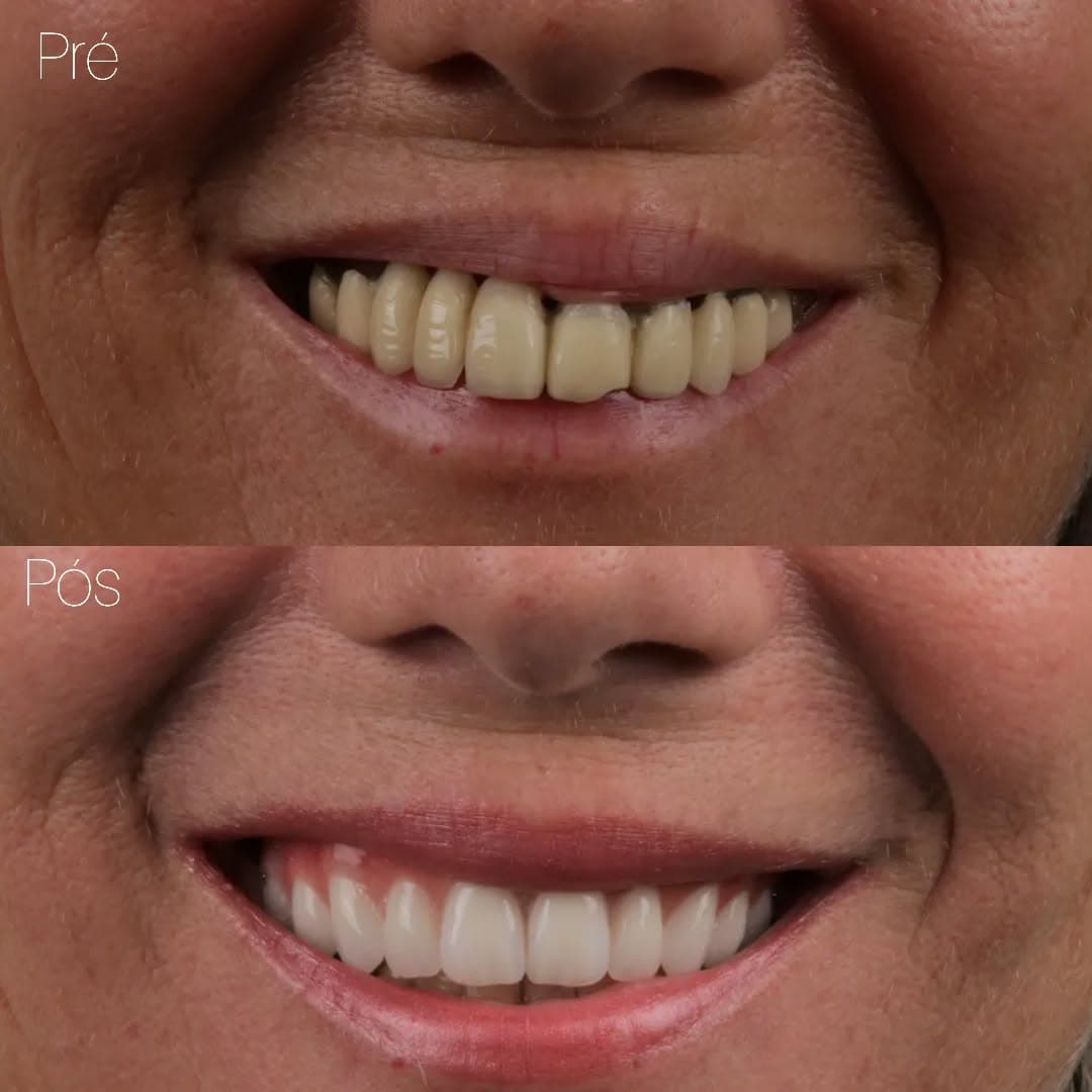 Depois — Restauração de sorriso completa