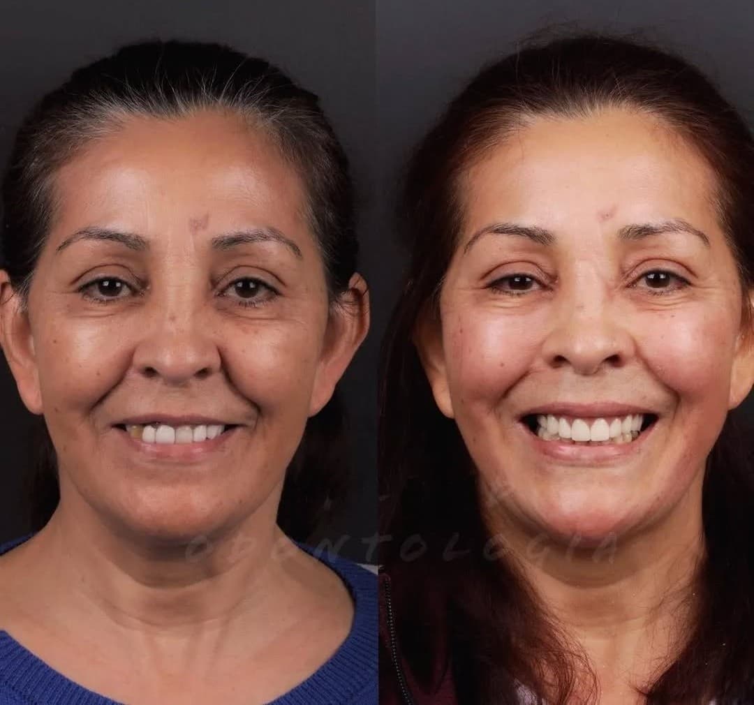 Depois — Antes e depois rosto inteiro